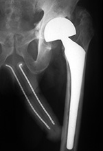Malleable penile prosthesis and bipolar hip prosthesis