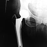 Right hip meta-on-metal arthroplasty