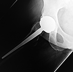 Right hip metal-on-metal arthroplasty