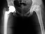 Right hip metal-on-metal THA