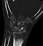 Scaphoid fracture