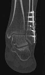 Fracture union
